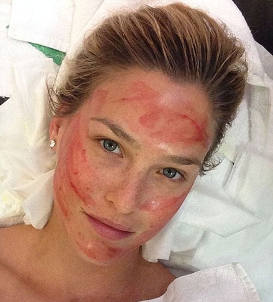 Bar bekämpft Fältchen mit 'Vampir-Lifting'