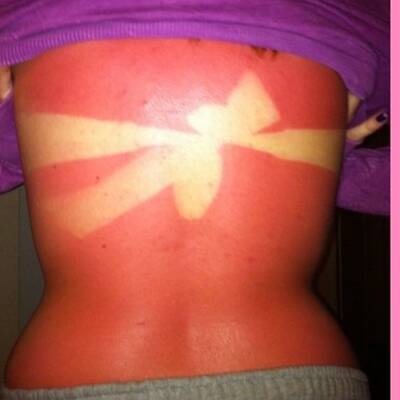 Die schlimmsten Sonnenbrände der Welt