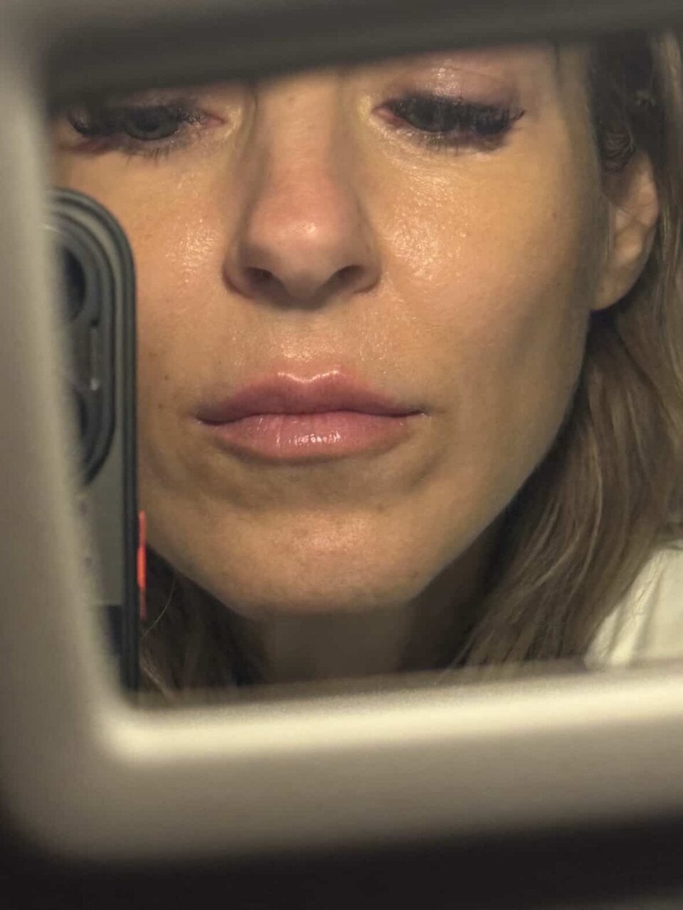 Das Endergebnis: Simone Lugner hat nun vollere Lippen.