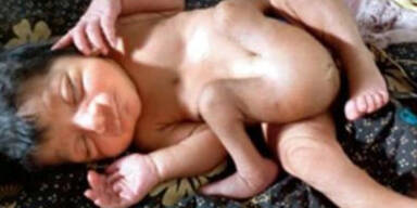 Baby mit vier Beinen und zwei Penissen