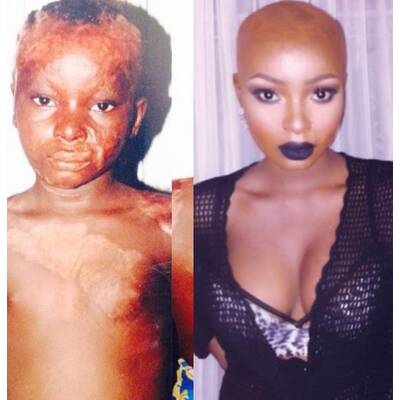 Brandopfer macht anderen Mut