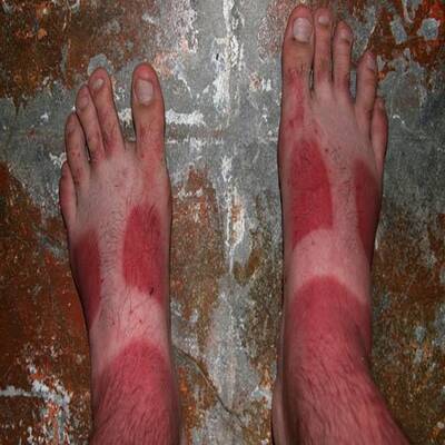 Die schlimmsten Sonnenbrände der Welt