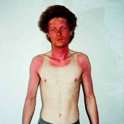 Die schlimmsten Sonnenbrände der Welt