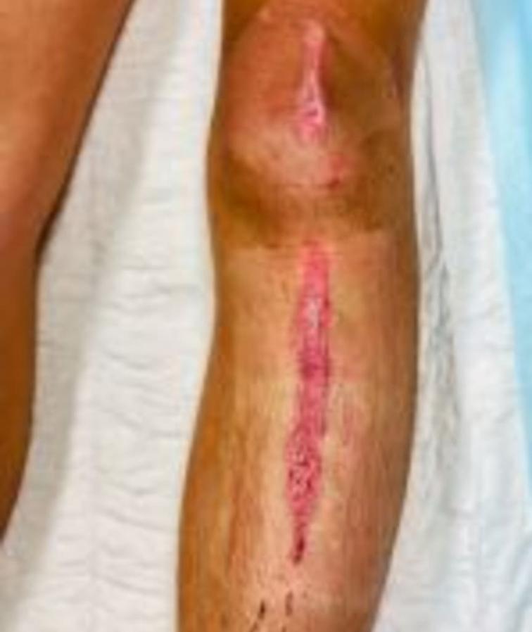 Junge (14) landet nach Squid Game-Challenge im Krankenhaus