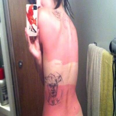 Die schlimmsten Sonnenbrände der Welt