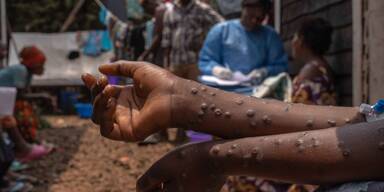 Mpox in Afrika