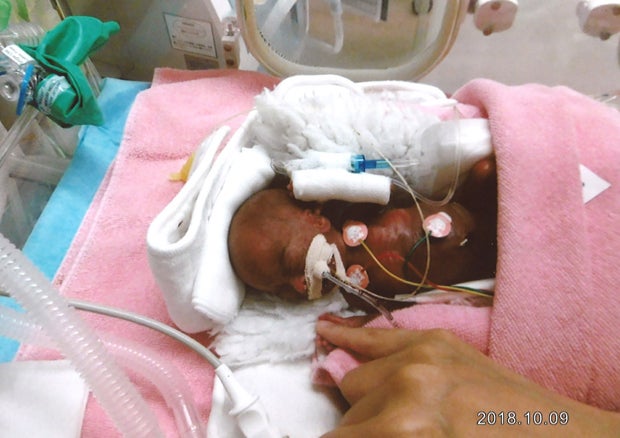 Kleinstes Neugeborenes der Welt darf Spital verlassen