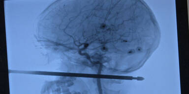 Bub (10) &uuml;berlebt Sturz auf Grillspie&szlig;