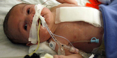 Baby mit Herz außerhalb des Brustkorbs operiert