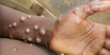 Affenpocken
