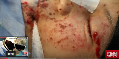 Bomben-Baby von Aleppo wird leben