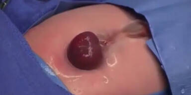 Baby w&auml;chst Herz au&szlig;erhalb der Brust