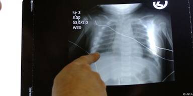 Bioresorbierbare Materialien werden vom K&ouml;rper abgebaut