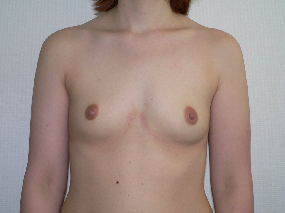 Prof Hernuss Brustvergrößerung Vorher Nachher