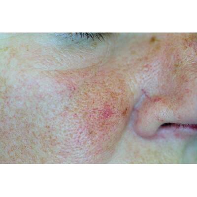 Couperose nach der Laserbehandlung