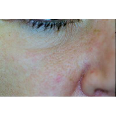 Couperose nach der Laserbehandlung