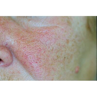 Couperose nach der Laserbehandlung