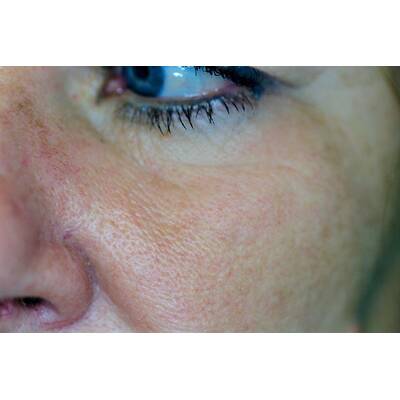 Couperose nach der Laserbehandlung