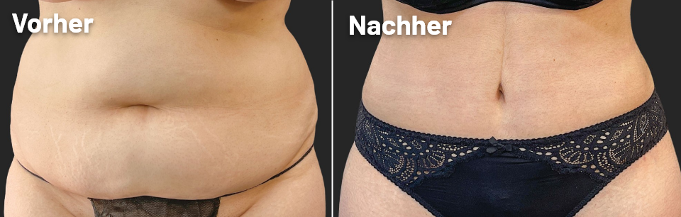 SILHOUETTA® – Dein Bauch in Harmonie