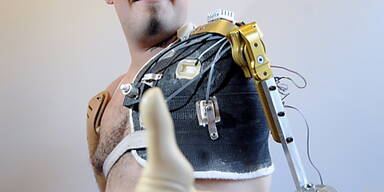 Erste gedankengesteuerte Prothese