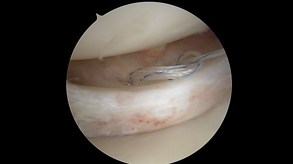 Warum der Meniskus genäht wird