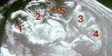 12-fache Mutter bekommt F&uuml;nflinge