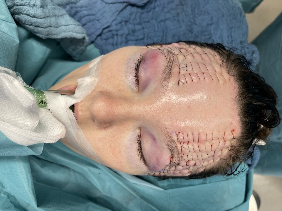 Gliding Brow Lift: Das neue Lifting der Brauen