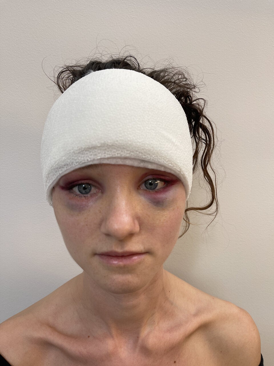 Gliding Brow Lift: Das neue Lifting der Brauen