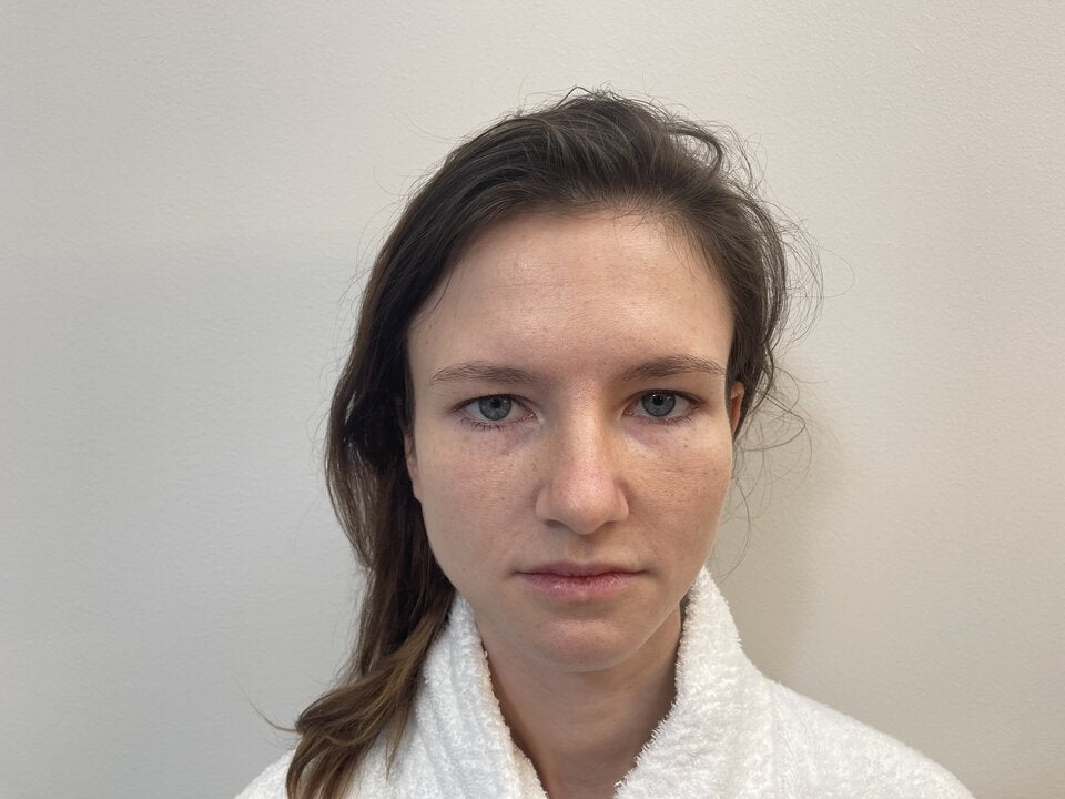 Gliding Brow Lift: Das neue Lifting der Brauen