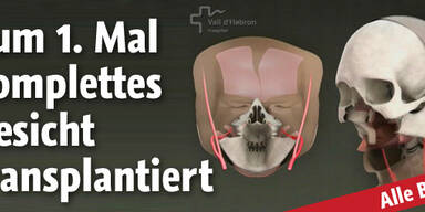Komplettes Gesicht transplantiert