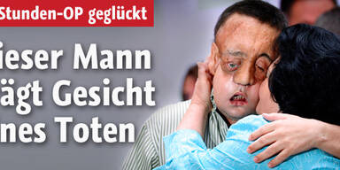 Erste Gesichts-Transplantation geglückt