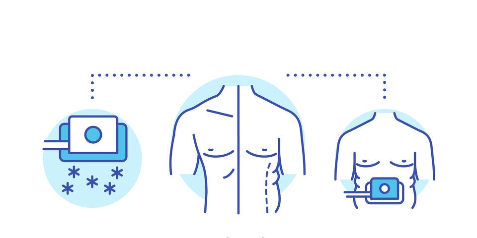 Kryolipolyse: Körperfett mit Kälte wegschmelzen