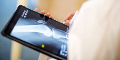 Studie am AKH Wien: Osteoporose erkennen, noch bevor es kracht