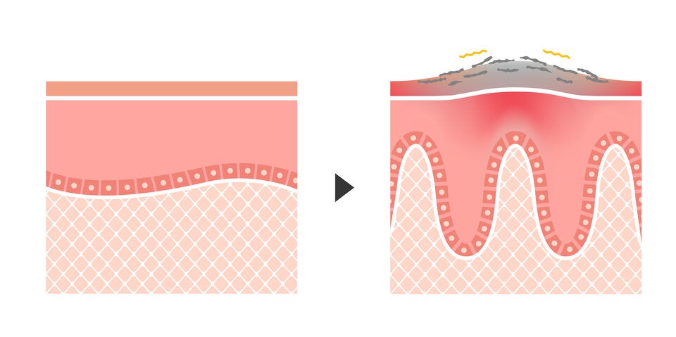 Bei Psoriasis gerät die körpereigene Abwehr aus dem Gleichgewicht und durch ihre Fehlfunktion werden Botenstoffe ausgeschüttet, die eine Entzündung anstoßen.