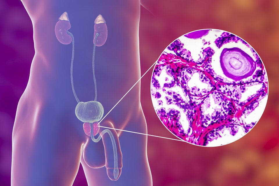 Prostatakrebs: Deshalb lassen sich Männer jetzt einen Schnauzer wachsen