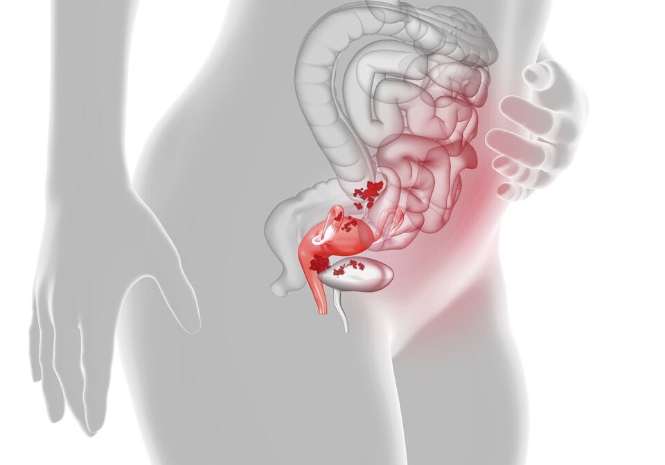 Endometriose: Ein Überblick