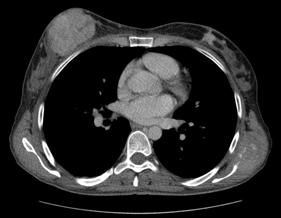 Studie deckt auf: So oft trifft Brustkrebs mittlerweile Frauen unter 40