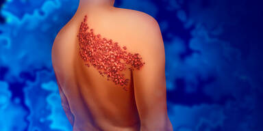 G&uuml;rtelrose: Deshalb erkranken immer mehr