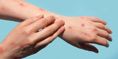 Masern-Ausbruch: Wie gefährlich ist die Krankheit?