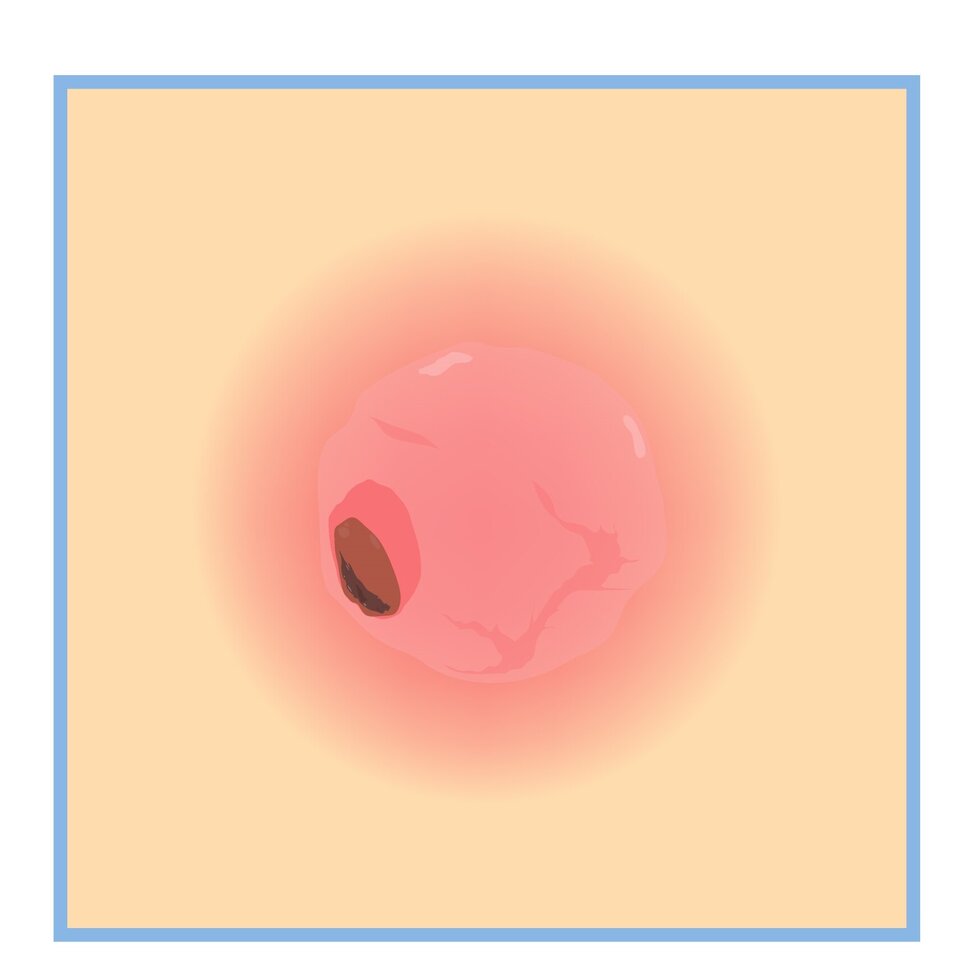 Neue Hoffnung bei Hautkrebs