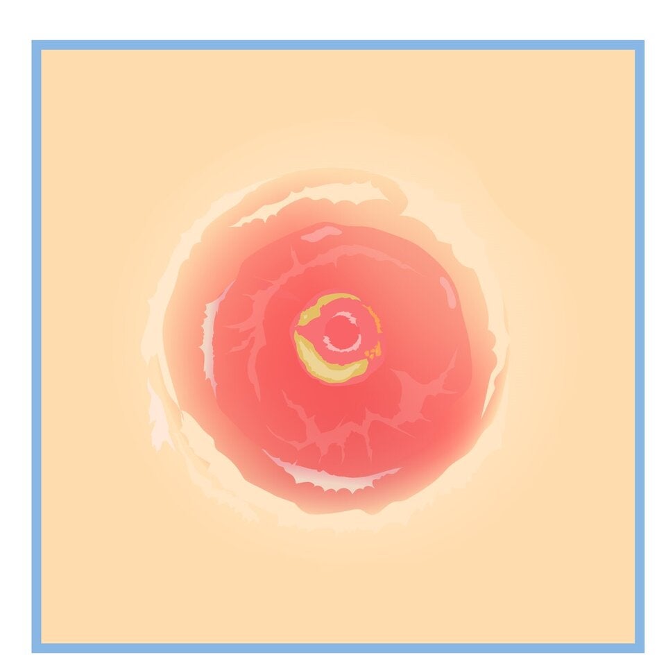 Neue Hoffnung bei Hautkrebs