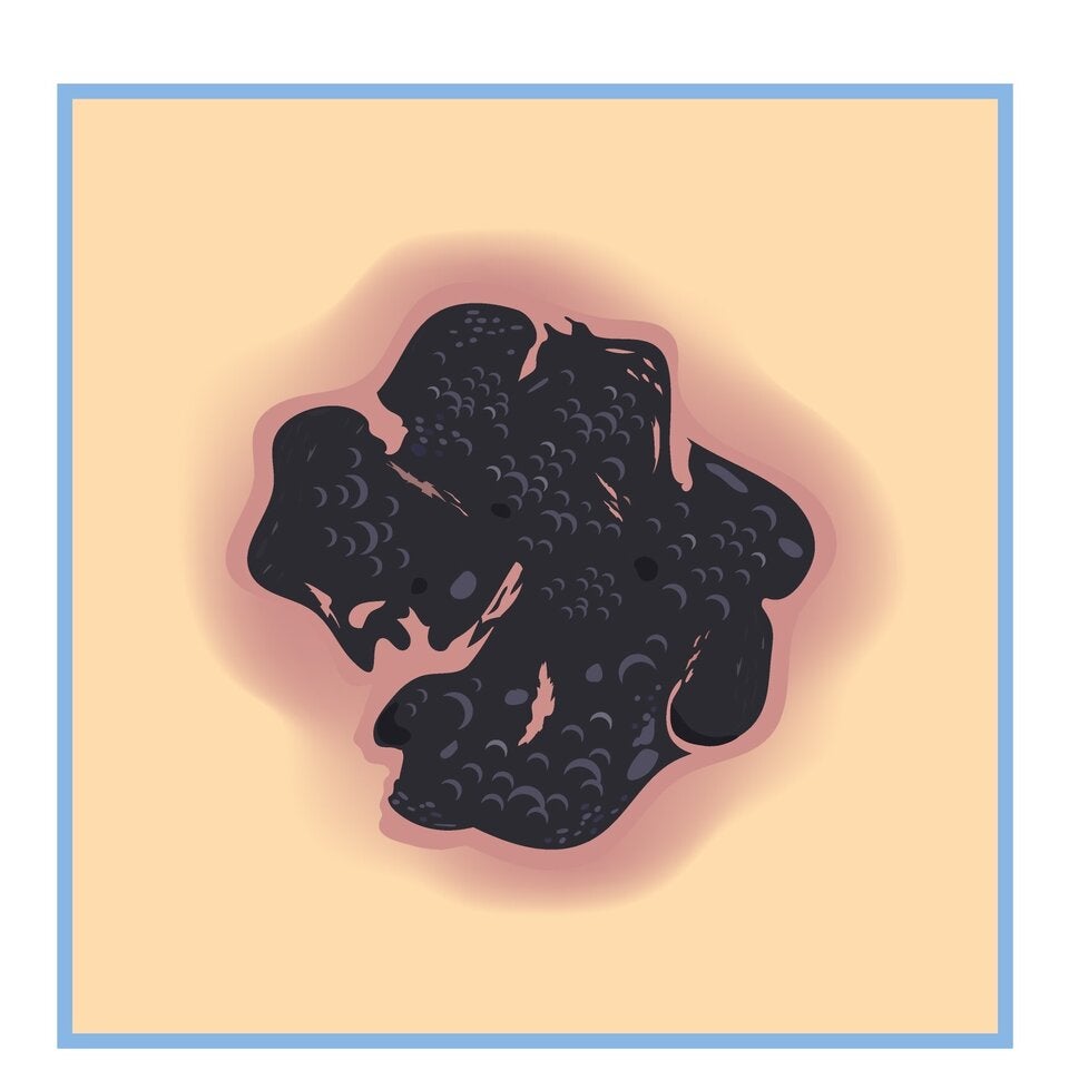 Neue Hoffnung bei Hautkrebs