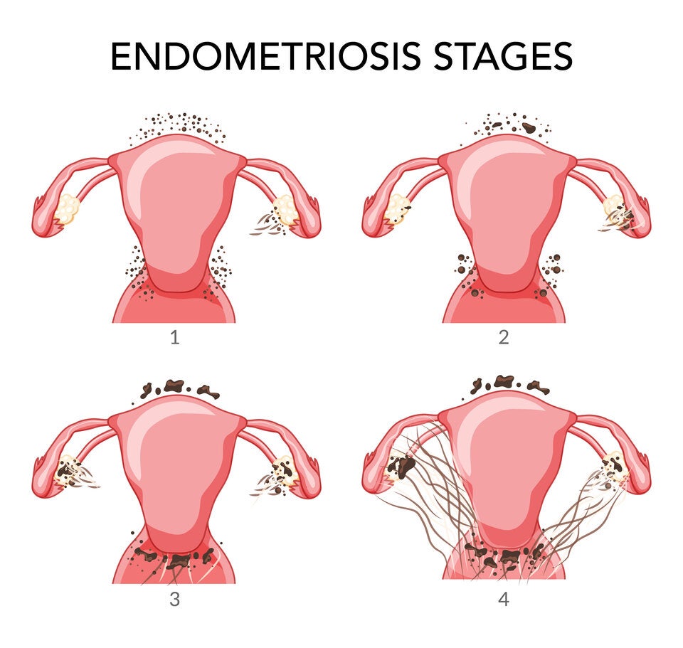 Endometriose: Ein Überblick