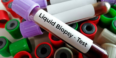 Liquid Biopsy