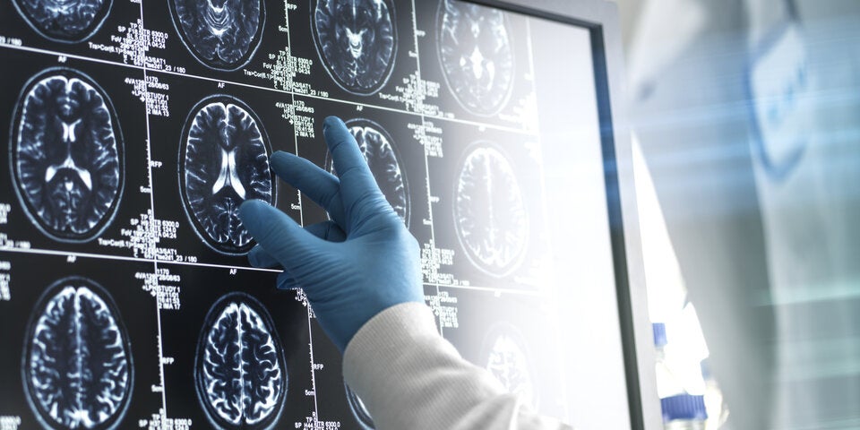 Die drei effektivsten Maßnahmen zum Schutz vor Demenz