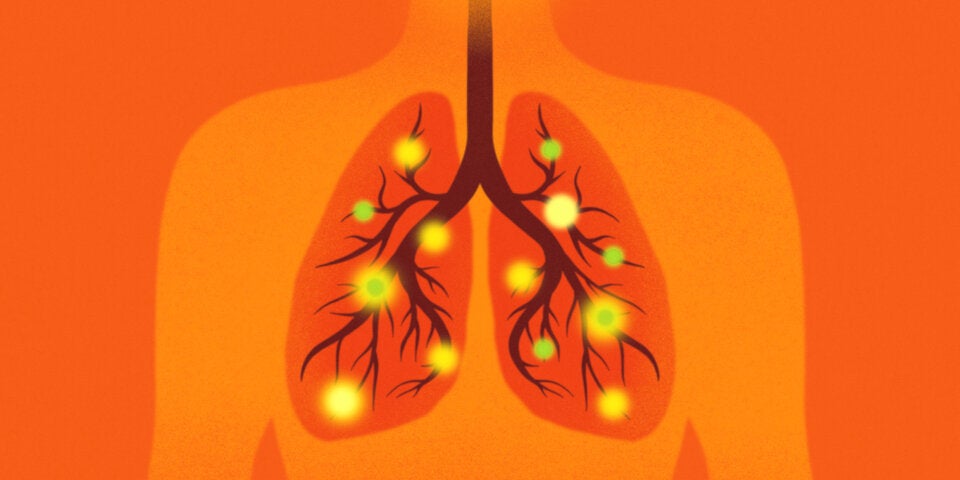 Die Bronchien sind weit verzweigt. An ihrem Ende befinden sich die Lungenbläschen.