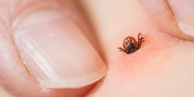 Zeckenstich erkannt – was jetzt? Auf diese Symptome müssen Sie achten