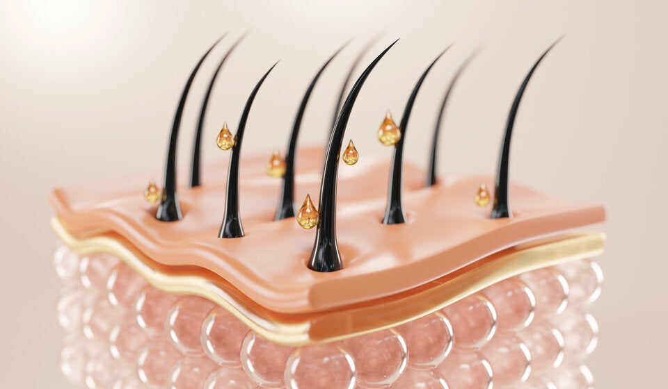 Als Therapie bei genetisch und hormonell bedingtem Haarausfall hat sich das Mittel „Minoxidil“ bewährt. 