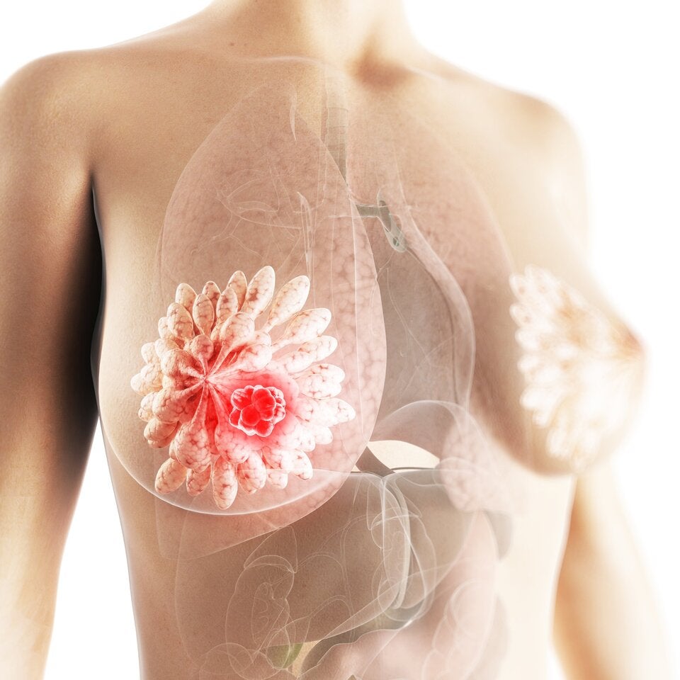 Etwa 75 Prozent der Brustkrebsdiagnosen sind auf hormonsensiblen Brustkrebs zurückzuführen.