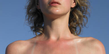 SOS-Hilfe bei Sonnenbrand & Co.